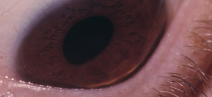 wat is keratoconus voor oogaandoening